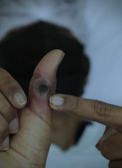 Fotografía que muestra las marcas que causa en el cuerpo la mpox.