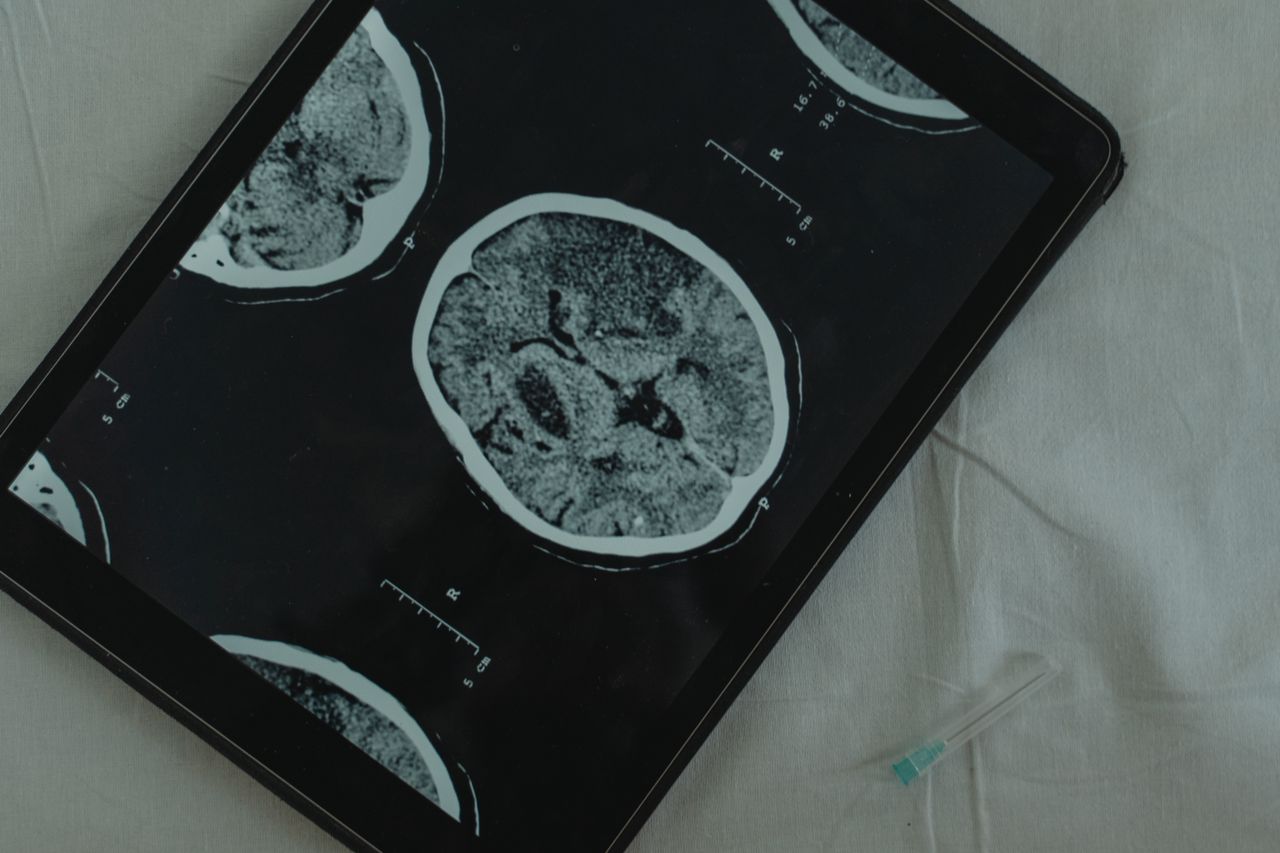 Corea del Sur anuncia un implante cerebral realizado a 10.596 kilómetros de distancia