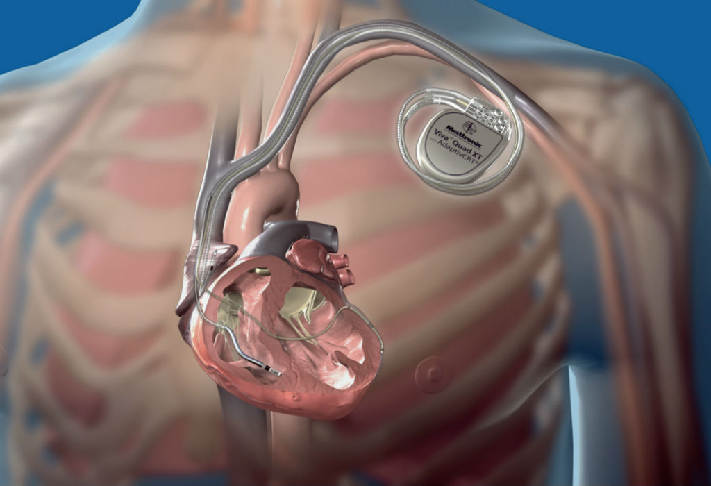 Dispositivos para insuficiencia cardíaca | Vistazo